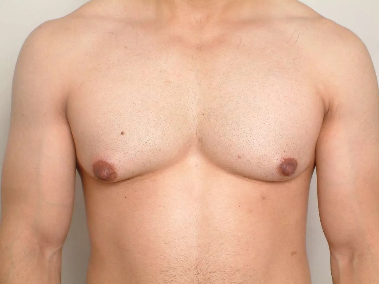 Unilateral gynaecomastia in Hyderabad screenshot 1