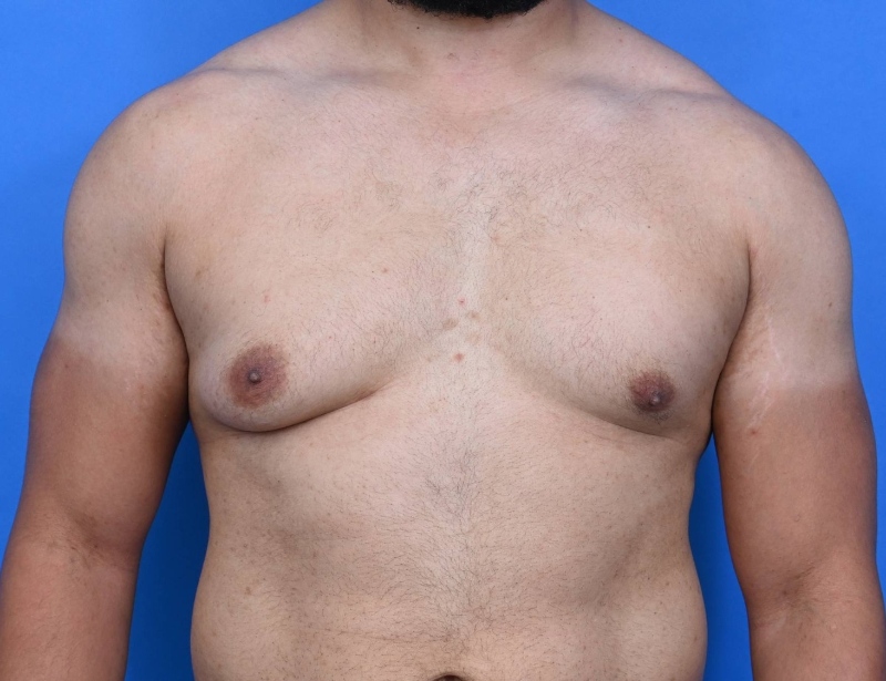 Skin excision gynaecomastia surgery cost in Hyderabad screenshot 1